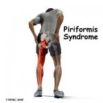 piriformis-syndrome-Rehabilitation-and-stretching.jpg